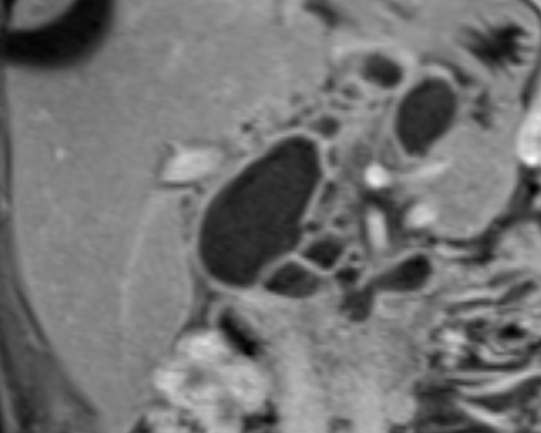 Figure 2: Showing the retropancreatic extension.