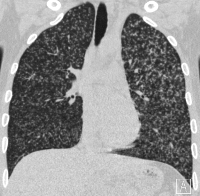 Figure 4: MiIiary tuberculosis. Low dose chest CT showing numerous well defined micronodules with random distribution. Axial reconstruction.