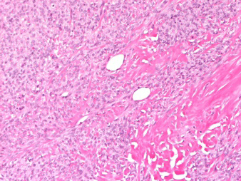 Figure 1: Fibrothecoma of testis delineating a storiform pattern composed of spindle shaped cells surrounded by collagen rich stroma with innumerable blood vessels and foci of haemorrhage [6].