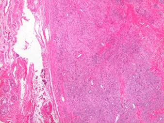 Figure 2: Fibrothecoma demonstrating fascicles of spindle shaped cells encompassed within a collagen rich stroma with several blood vessels and foci of haemorrhage [6].