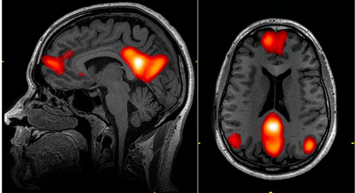 Figure 12: Background Network - Default Mode [8].