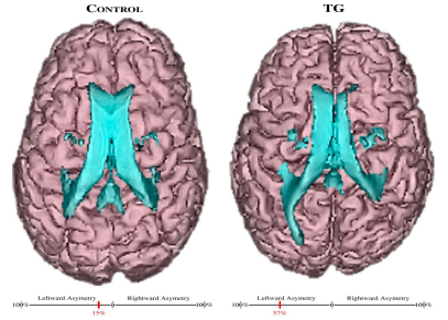 Figure 18: Diffusion Tensor Imaging (DTI) on Temple Grandin [40].