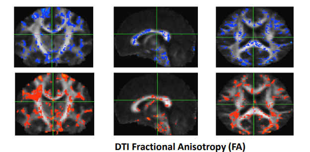 Figure 19: Functional MRI (f-MR) on Temple Grandin [40].