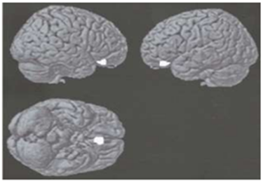 Figure 2: Area of ​the Human Brain Stimulated by Beautiful Pictures [9].