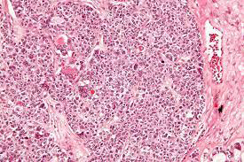 Figure 1: Juvenile granulosa cell tumour enunciating solid sheets and irregular clusters of tumour cells pervaded with moderate eosinophilic cytoplasm and regular ovoid nuclei. Tumour cell clusters are traversed by mature fibrous tissue septa [5].