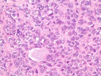 Figure 2: Juvenile granulosa cell tumour delineating follicular structures composed of neoplastic cells permeated with abundant, eosinophilic cytoplasm and uniform, ovoid nuclei. Surrounding stroma is fibrotic [6].