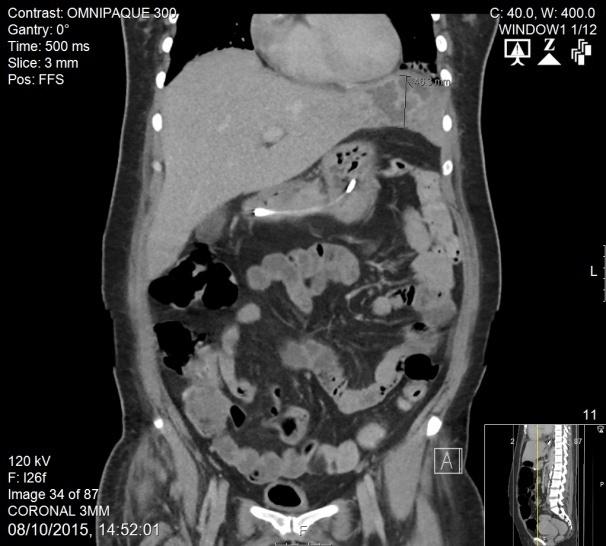 Figure 1: CT abdomen scans with contrast, on day 2 of admission. A hypo dense lesion of size 6.5cm by 5.5cm is visualized in the left lobe of the liver.
