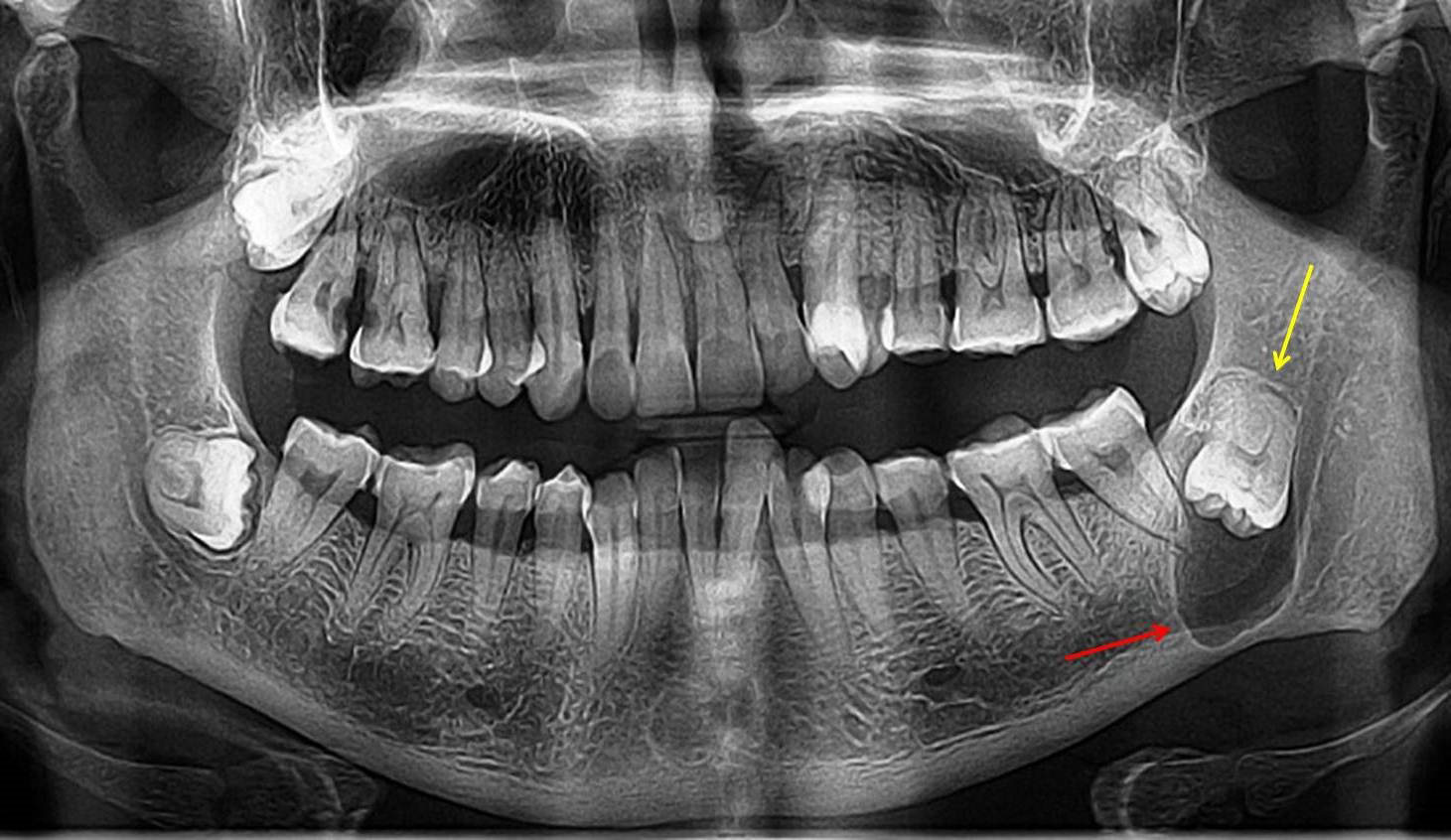 Figure 1: Radiograph Showing Impacted and Inverted Mandibular Left Third Molar in Ascending Ramus of the Mandible. The Crown is Facing Downward with its Roots Upward (Yellow Arrow). It is surrounded by a Radiolucent Cystic Lesion (Red Arrow), Eroding Mandibular Canal and Extending to Inferior Border of the Mandible. Right Side, the Third Molar is in Horizontal Impaction Position.