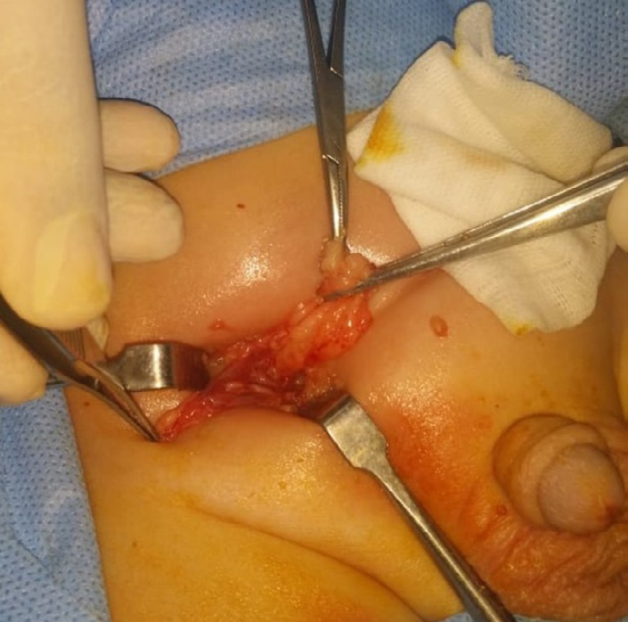 Figure 1: Case1, Right Side Direct Inguinal Hernia.
