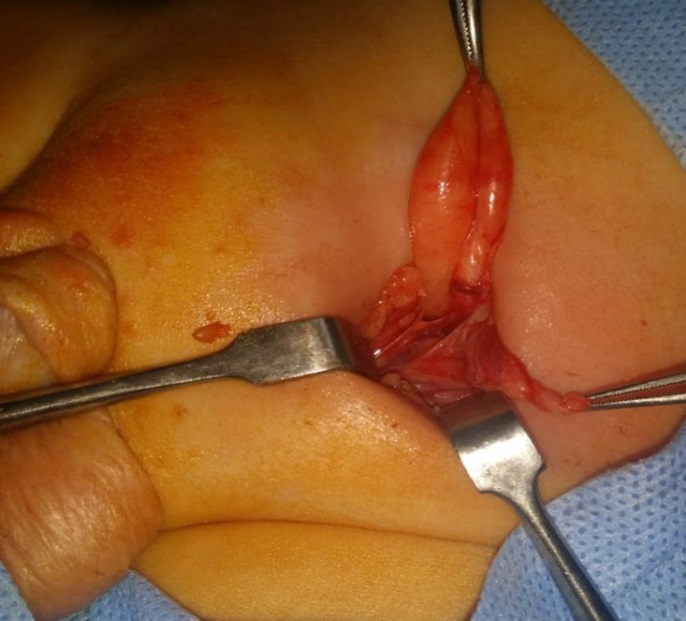 Figure 2: Case1, Left Side Direct Inguinal Hernia.