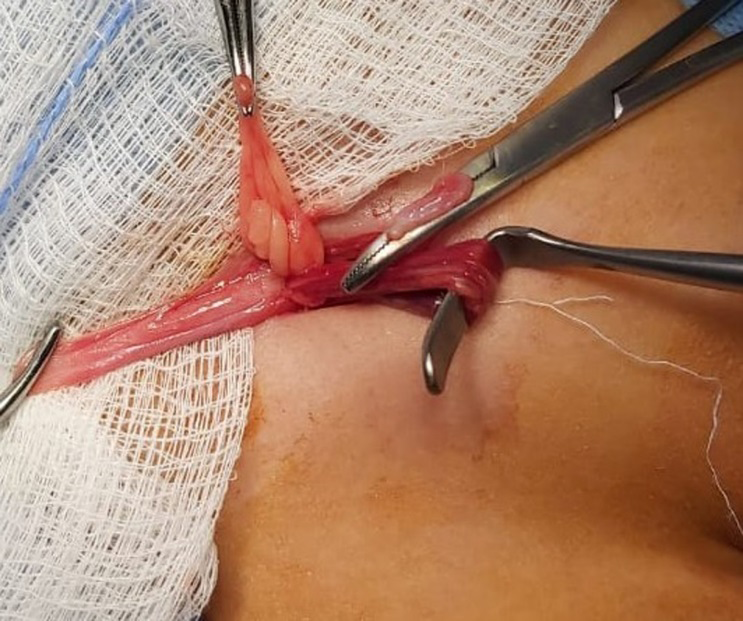 Figure 3: Case 2, Right Side Direct Inguinal Hernia and Sac of Indirect Type.