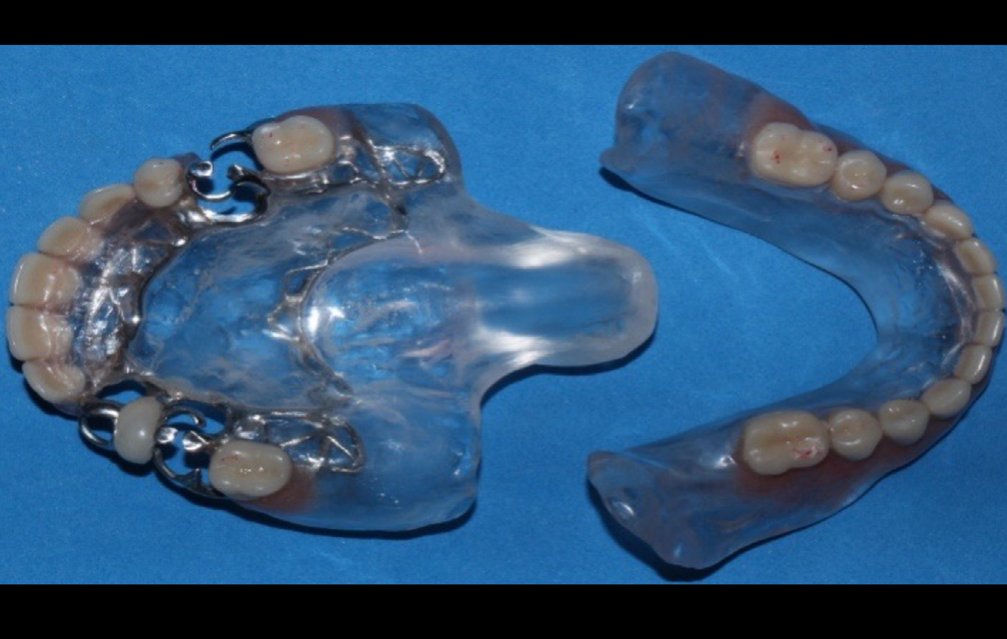 Figure 3: Oropharyngeal obturator prosthesis and mandibular total prosthesis after acrylization.