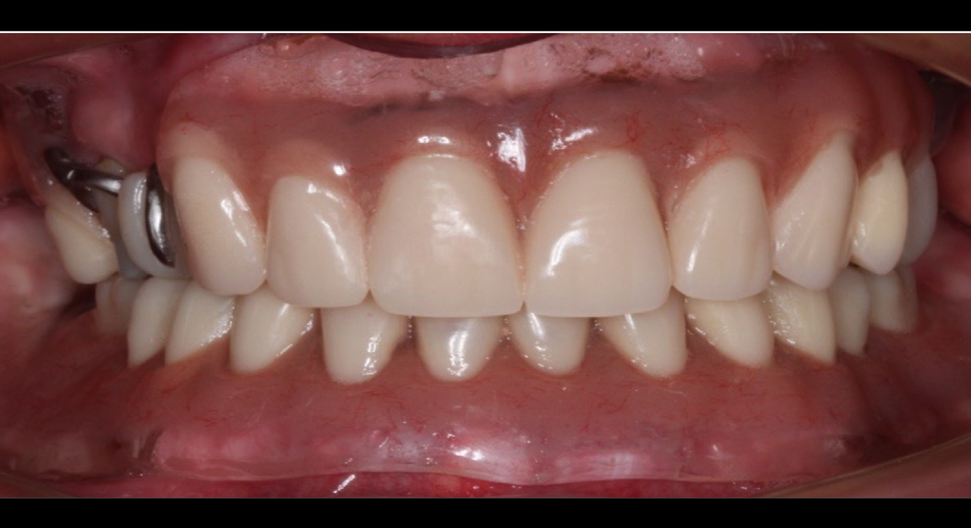 Figure 5: Intraoral view and patient’s smile while wearing oropharyngeal obturator and complete denture.