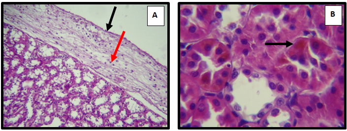 Figure 2: Kidney of adult male rat treated with Sodium Molybdate 50 mg /Kg/ B.W at 60 day, showing (A) marked fibrous thickening the capsule ( ) (H&E 10X). And (B) severe cortical hemosiderosis (