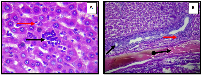 Figure 5: Liver of adult male rat treated with sodium molybdate 50 mg/Kg/B.W and Sodium sulfate500 mg/Kg/B.W (combination) for 60 day, showing (A) mild infiltrate of mononuclear cell within the hepatic paranchyma ( ) and prolifration of kupffer’s cells ( ) in the portal area with hyperplasia of bile ductules ( ) and severe diltation of hepatic artery contain inflammatory cell and serum protien in lumen (