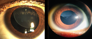 Figure 3: Bilateral Superonasal ectopia lentis.