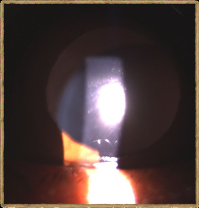 Figure 4: Ectopia lentis with cataract.