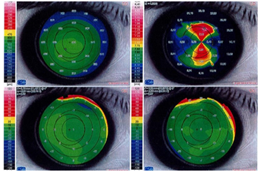 Figure 1: RE first topography.