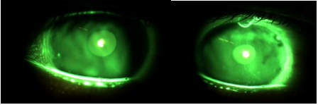 Figure 5: RE cornea without lens, no staining or other problems and bulge at 12 o’clock.