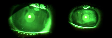 Figure 6: LE cornea without lens, no staining or other problems and bulge at 12 o’clock.