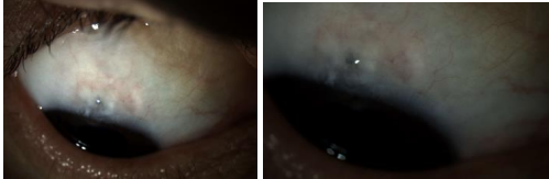 Figure 7: RE bulge.