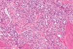 Figure 1: Kaposiform hemangioendothelioma delineating clusters and aggregates of spindle-shaped cells surrounded by thin walled, ectatic vascular articulations. Infiltration into circumscribing stroma is observed [5].