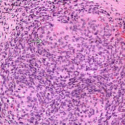 Figure 2: Kaposiform hemangioednothelioma demonstrating clusters and aggregates of spindle-shaped cells encompassed within thin walled ectatic vascular structures. Infiltration into surrounding stroma is exemplified [6].