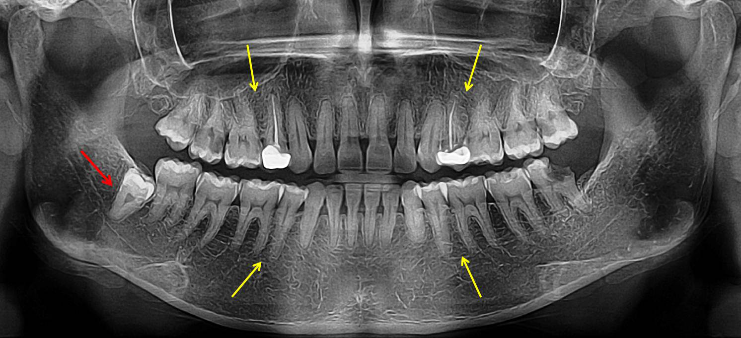 Figure 1: Radiogrpah (Orthopantomograph) showing distomolar (retromolar/fourth molar) in the mandibular right quadrant located distal to the third molar (red arrow) and congenital agenesis of all four maxillary and mandibular right and left second premolars (yellow arrows).