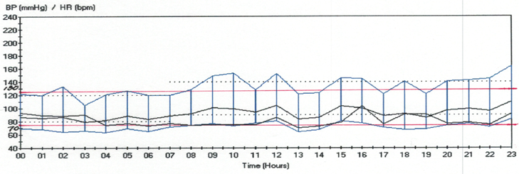 Figure 1: Ambulatory Blood Pressure chart of the patient for 24 hours. shows systolic, diastolic pulse pressure and heart rate (Patient’s Personal Data).