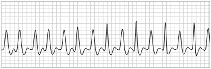 Figure 13: Typical Pulse wave measurements using Vas Pad ( LD Technologies, Miami Florida. (Courtesy: Albert Maarek, CEO, LD Technologies).