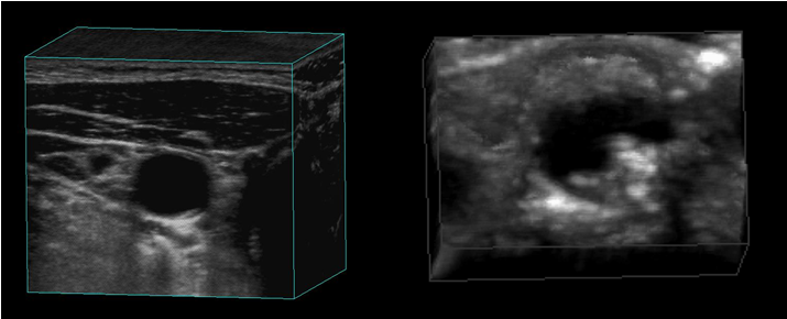 Figure 4: Compared to a scan of a patient with advanced atherosclerotic plaque (B), his carotid artery was relatively free of any visible plaques. In a bilateral carotid ultrasound doppler study in 2010, minimal homogenous plaque formation was recorded without any flow disturbances.