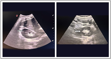 Figure 3: Transabdominal ultrasound image showing normal kidneys.