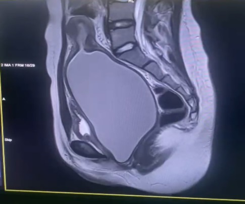 Figure 4: MRI image showing substantial vaginal distension (hematocolpos).