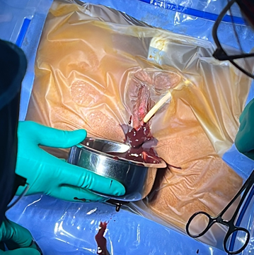 Figure 5: Removal of thick, Dark-Colored Blood Following Hymen Incision.