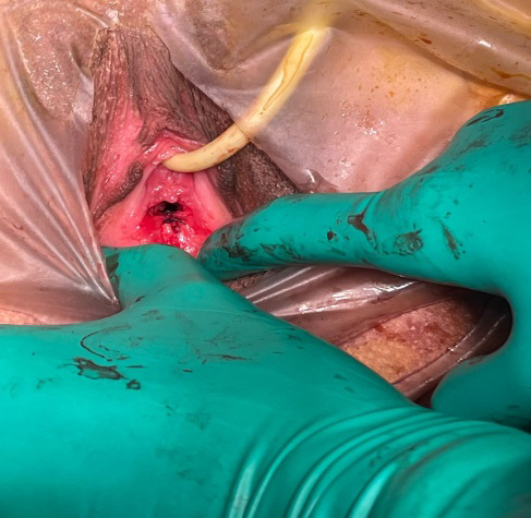 Figure 6: Correction after Hymenectomy.