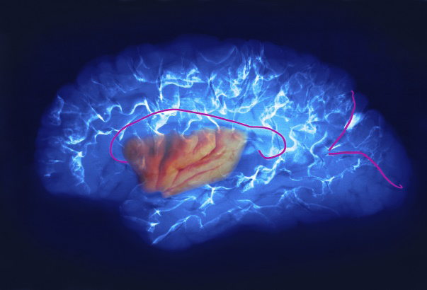 Figure 2: The insula image superimposed with a blue radiogram of the left cerebral hemisphere. Note a radiocontrast substance within the grooves. The pink lines denote the callosal groove above the insula level, and the parieto-occipital and calcarine sulci posteriorly.