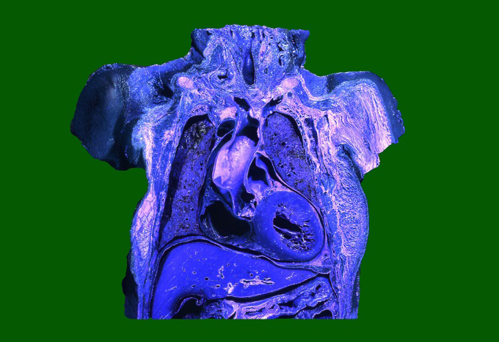 Figure 6: A coronal anatomic section of an old female thorax and the upper abdomen subsequently colorized. Note a hypertrophy of the left ventricle myocardium.