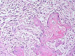 Figure 1: Metaplastic carcinoma breast demonstrating aggregates of squamous epithelial cells admixed with mesenchymal elements as chondroid tissue and spindle shaped cells [5].