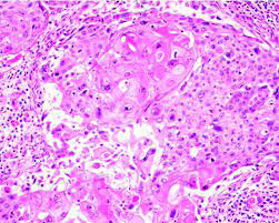 Figure 2: Metaplastic carcinoma breast delineating aggregates of squamous epithelial cells commingled with mesenchymal elements as spindle shaped cells and cartilaginous foci [6].