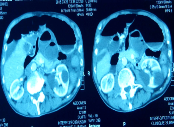 Figure 1: CT Image of the Internal Hernia via the Winslow Hiatus.