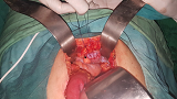 Figure 10: Intraoperative Photo of Supravesical Hernia Orifice Closure.