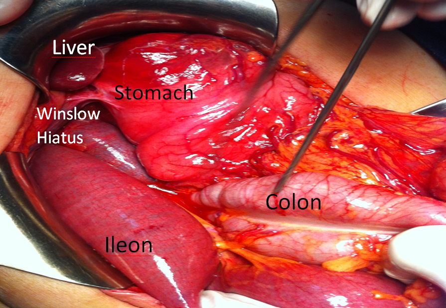 Figure 2: Per-operative Photo of Internal Hernia Via Winslow Hiatus.