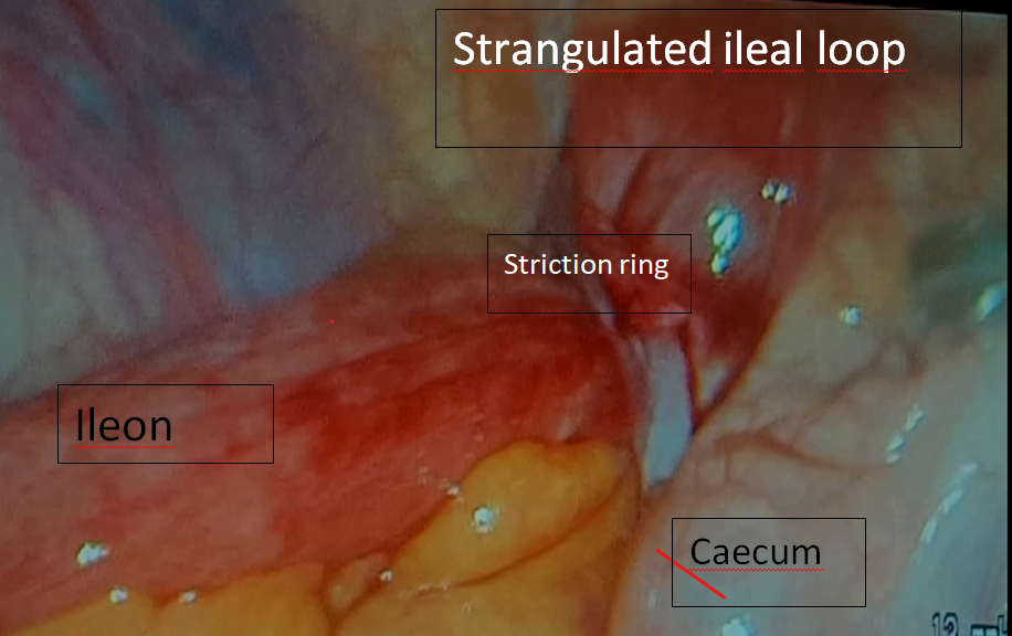Figure 3: Intra operative Photo of Internal Retrocaecal Hernia.