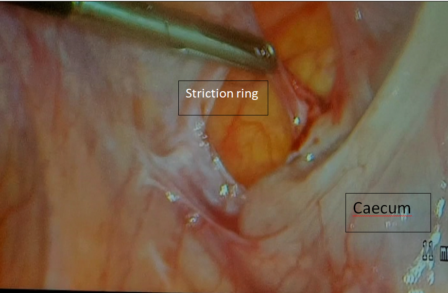 Figure 4: Intra operative Photo of the Retrocaecal Hernia Orifice.