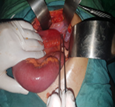 Figure 7: Intraoperative Photo of a Supravesical Internal Hernia.