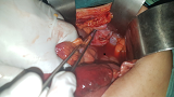 Figure 8: Intraoperative Photo of the Supravesical Hernia Orifice.
