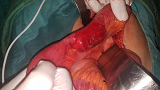 Figure 9: Intraoperative Photo of the Loop Incarcerated in the Supravesical Hernia Orifice.