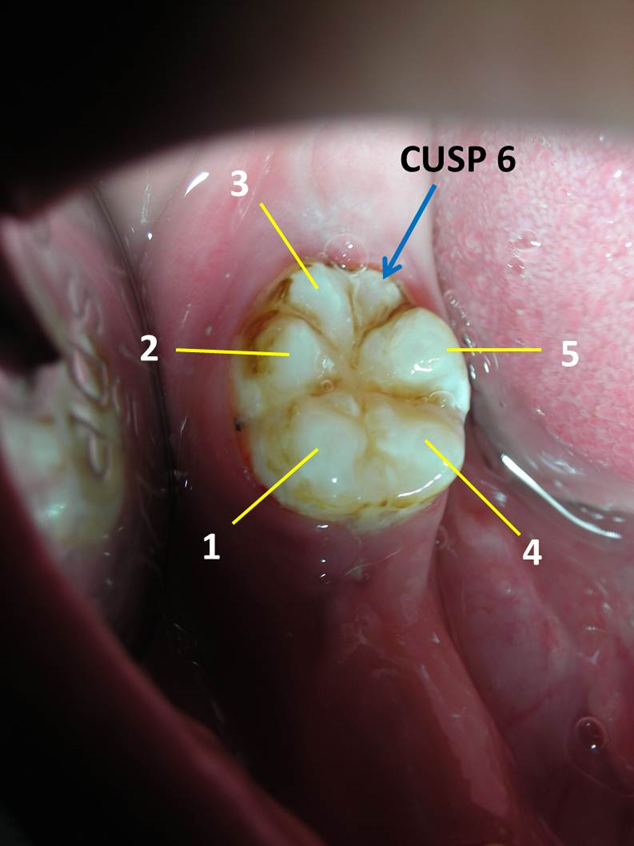 Figure 1: Intraoral photograph showing presence of “Tuberculum Sextum” or “Cusp 6” or “Entoconulid” (blue arrow) in the permanent mandibular first molar. Yellow lines indicate presence of Normal number of cusps.