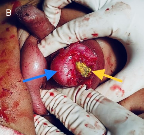 Figure 2: A. On Scrotal exploration, yellow greenish calcification material expressed from paratesticular tissues (white arrow), ipsilateral testis is normal (yellow arrow). B. After complete dissection, the calcifications (yellow arrow) were seen. Blue arrow represent normal ipsilateral testicle.