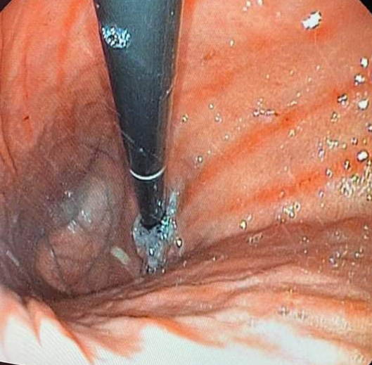 Figure 2: Retro-mink gastroscopy showing an erythematous and linear gastric mucosa at the fundal level.